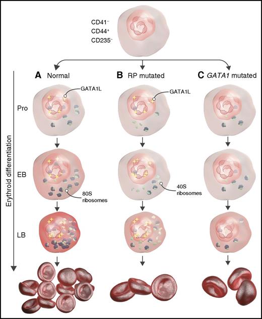 Schematic representation describing the role of RP and GATA1 mutations during erythropoiesis in DBA. (A) Under normal conditions, long-form GATA1 (GATA1L) induces genes that promote translation and heme synthesis, resulting in adequate red-cell production. (B) In RP-mutant cells, GATA1L induces genes responsible for heme synthesis and translation, but defective ribosomal assembly leads to aberrant erythropoiesis and anemia. (C) Mutated GATA1 results in decreased expression of genes encoding the translational apparatus and heme synthesis despite normal ribosome assembly, resulting in anemia. EB, early basophilic erythroblasts; LB, late basophilic erythroblasts; Pro, proerythroblasts. The figure has been adapted from Figure 7 in the article by O’Brien et al that begins on page 3111.