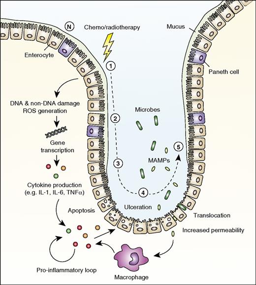 Figure 4. Role for IL-1 in mucosal barrier injury. The development of mucosal barrier injury (mucositis) is traditionally described as consisting of 5 stages. (1) DNA and non-DNA damage is initiated by chemotherapy or radiotherapy, and ROS are generated. (2) Transduction pathways are activated, stimulating transcription factors such as NF-κB. Many genes are upregulated, resulting in the production of proinflammatory cytokines (eg, TNFα, IL-1β, and IL-6), after which epithelial cell death and injury occur. (3) Primary damage is amplified by a positive-feedback loop of proinflammatory cytokines. (4) Ulceration occurs, and increased permeability with impaired tight junctions results in bacterial translocation. (5) Repair and healing. N indicates normal mucosa in the small intestine.
