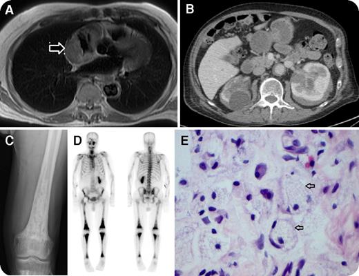 An 80-year-old man was noted to be bradycardic while being transferred to the United Kingdom following neck of femur fracture abroad. He had a 3-month history of weight loss, pruritus, and bone pain. Echocardiogram and cardiac magnetic resonance imaging showed a concentric right atrial mass causing luminal narrowing (panel A, arrow), pericardial effusion, and circumferential infiltration of descending aorta and arch adventitia. Bilateral perinephric soft tissue infiltration was found on computed tomography scan of his abdomen (panel B). Skeletal radiographs demonstrated bilateral patchy sclerosis of the metaphyses of the distal femora (panel C), as well as generalized increased uptake of long bones on nuclear medicine bone scan (panel D). Biopsy of the perinephric tissue revealed infiltration by lipid-laden histiocytes (panel E, arrows; original magnification ×100, hematoxylin and eosin stain), which were strongly positive for CD68 and factor 13a, but negative for S100 and CD1a, confirming the diagnosis of Erdheim-Chester disease. BRAFV600E mutational testing, using pyrosequencing on the perinephric and bone biopsy tissues, was negative. / Erdheim-Chester disease is a rare multisystem non–Langerhans cell histiocytic disorder. Symmetrical long bone osteosclerosis sparing the epiphyses and axial flat bones is the commonest manifestation of the disease. Cardiac involvement is present in about a third of cases. However, a large atrial mass with impending superior vena cava obstruction is relatively uncommon.