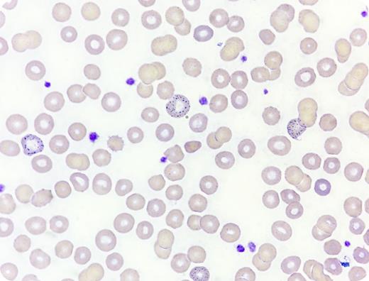 A 62-year-old woman presented with persistent periumbilical pain. She was found to have normochromic normocytic anemia (hemoglobin, 6.4 g/dL) and mild renal impairment (urea, 6.2 mmol/L; creatinine, 149 µmol/L). Gastrointestinal endoscopy was unrevealing. After admission, the patient developed generalized seizure. Blood film examination revealed frequent coarse basophilic stippling of red cells (original magnification ×100, Wright-Giemsa stain). Blood lead level was markedly raised (151 µg/dL; normal is <5 µg/dL). Dimercaptosuccinic acid chelation was commenced with subsequent improvement in hemoglobin level and renal function. Further history revealed that the patient consumed multiple herbal supplements for more than 1 year. A local toxicology reference laboratory detected extremely high lead levels in 1 of the herbal supplements (108 389 µg/mL). For reference, the US Food and Drug Administration adopts 0.5 µg/mL as the maximum level allowed for lead in products intended for use by children. / A lead level of 150 µg/dL is potentially lethal and could be associated with nephropathy and encephalopathy. In contrast to fine basophilic stippling in thalassemia, basophilic stippling is typically coarse in lead poisoning as a result of precipitation of RNA secondary to pyrimidine-5′-nucleotidase inhibition. Coarse basophilic stippling is also reported in pyrimidine-5′-nucleotidase deficiency and arsenic poisoning.