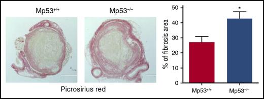 Histochemical analysis of intrathrombotic collagen content by Picrosirius Red staining at day 12 after vena cava ligation; original magnification ×100. Representative images from 4 to 5 independent mice of each genotype are shown. The intrathrombus collagen area was quantitated as a measure of fibrosis, as described in “Methods” in the article by Mukhopadhyay et al. All values represent the mean ± SEM (n = 4-5). *P < .05, p53 Mp53+/+ vs Mp53−/−. See Figure 5D in the article by Mukhopadhyay et al that begins on page 3245.