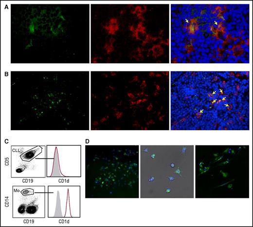 Figure 4. Monocytes and NLCs from CLL patients express CD1d. (A-B) CD1d expression by NLCs in vivo. Frozen lymph node sections from 2 patients with progressive CLL co-stained with anti-CD1d mAb plus goat anti-mouse fluorescein isothiocyanate (FITC) (green), anti-CD68 mAb plus goat anti-rabbit phycoerythrin (PE) (red) Abs, and DAPI (blue). Macrophages co-expressing CD1d and CD68 (yellow arrows) are detectable scattered within (A) dense macrophage infiltrates (original magnification ×400) or in (B) macrophage clusters (original magnification ×200), surrounded by lymphoid elements compatible with CLL cell morphology. Sections were analyzed with a Zeiss AXIO Scope.A1 optical microscope (Zeiss, Oberkochen, Germany). Images were collected with Zeiss Axiocam 503 Color. (C) Representative CD1d expression detected by flow cytometry in circulating monocytes from 1 of 10 CD1dneg CLL patients. (D) CD1d expression by NLCs differentiated in vitro from patients’ PBMCs. Adherent cells were stained with anti-CD1d mAb plus goat anti-mouse PE (green) and DAPI (blue). (Left panel) CD1d expression by immunofluorescence analysis in 1 representative field (original magnification ×20) of 20 to 40 fields per patient performed on 6 patients. (Middle panel) Bright field (gray) merged with CD1d immunofluorescence and DAPI nuclei staining (original magnification ×20) showing NLCs with typical stellate morphology. Immunofluorescence was performed by In Cell Analyzer 1000 GE Healthcare and In Cell Analyzer 1000 Workstation or Arrayscan XTI (Thermo Fisher) with HCS studio software. (Right panel) The same NLCs were stained with anti-CD1d PE mAb and DAPI for confocal imaging. CD1d is localized on the cell surface and in punctate structures (original magnification ×63). Confocal imaging was performed with Confocal Microscope Leica TCS SP2.