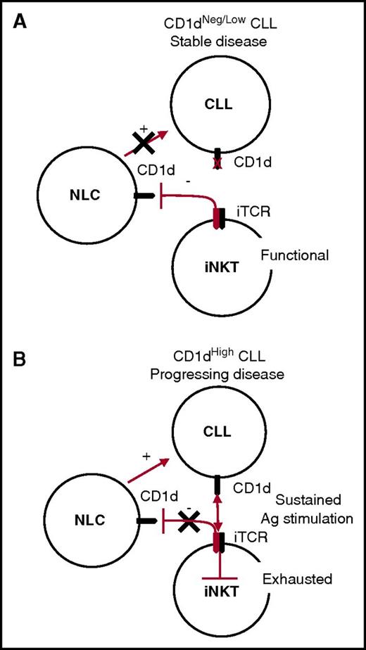 Figure 6. Unifying model for CLL surveillance by iNKT cells. (A) Stable disease correlates with absent or low CD1d CLL expression by CLL cells. In this situation, iNKT cells maintain normal frequencies and functions and the capability to constrain NLCs through a CD1d-cognate interaction, which has a negative impact on CLL survival. (B) Progressing disease correlates with high CD1d expression by CLL cells. In this situation, iNKT cells are persistently hyperstimulated by CLL cells in an antigen (Ag)-dependent fashion, leading to their exhaustion. As a result, iNKT cells no longer control NLCs, which can provide unconstrained support for CLL cell survival and proliferation.