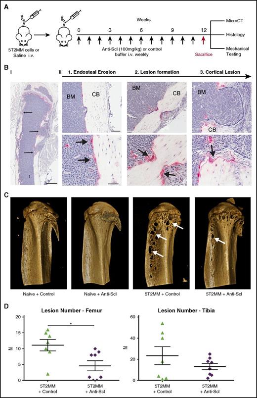 Figure 4. Treatment with anti-sclerostin antibody reduces formation of osteolytic bone lesions. (A) Schematic describing the study design for investigations of bone lesions in 5T2MM-bearing mice. (Bi) TRAP/hematoxylin-stained histologic section of a tibia from a 5T2MM-bearing mouse. Slides were scanned on a Scanscope CS2 (Aperio) up to original magnification ×40, and images were captured by using an Aperio Imagescope at digital magnification ×2. Scale bar represents 500 µm; black arrows point to cortical lesions. (Bii) Higher magnification (×12 and ×30) images that demonstrate the temporal development of CB lesions in the 5T2MM model. (1) Initial erosion of the endosteal surface of the CB by red TRAP-positive osteoclasts (black arrows) adjacent to tumor cells in the BM. (2) Formation of a CB lesion (blue dotted line) by osteoclasts (black arrows). (3) A cortical lesion that has penetrated the cortex with the tumor (blue dotted line) extending into the surrounding soft tissue. (Top panel) scale bar represents 100 µm; (bottom panel) scale bar represents 50 µm. (C) Representative 3D reconstruction of tibia from each treatment group showing full cortex penetration lesions (white arrows) in the 5T2MM+ control and 5T2MM+ anti-sclerostin antibody groups. (D) Dot plots of lesion number per bone for femora and tibiae (n = 7-8 per group; data are mean ± 1 SEM; *P < .05).