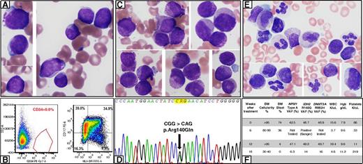 A 75-year-old woman was diagnosed with acute myeloid leukemia (AML). Bone marrow (BM) showed intermediate-sized blasts (78%) with scant agranular cytoplasm (panel A: Wright-Giemsa stain, original magnification ×1000) and occasional “fish-mouth” morphology. Auer rods were absent. Flow cytometry (FC) confirmed CD34-negative myeloblasts with CD117 and HLA-DR expression (panel B). Karyotype was diploid; next-generation sequencing (NGS) showed NPM1, IDH2, and DNMT3A mutations. She was treated on a clinical trial with azacitidine and an IDH2 inhibitor. Repeat BM (6 weeks) showed persistent AML. The blasts showed prominent cytoplasmic granulation: coarse primary (azurophilic) and fine secondary granules (panel C: Wright-Giemsa stain, original magnification ×1000). FC and IDH2 mutation analysis confirmed persistent disease (panel D, arrow). BM (12 weeks) showed 4% blasts. Many cells were difficult to characterize due to prominent cytoplasmic granulation (panel E: Wright-Giemsa stain, original magnification ×1000). FC was negative for residual disease; however, NGS showed all 3 mutations at a high allelic burden. BM (18 weeks) was negative by morphology and FC; NGS showed persistence of all 3 mutations (panel F: Hgb, hemoglobin; FITC-A, fluorescein isothiocyanate-A; PE-Cy7, phycoerythrin-cyanine 7; SSC-A, side scatter area; VAF, variant allele frequency; WBC, white blood cell). / The case illustrates the unique morphologic challenges encountered in this era of novel targeted therapies. IDH2 inhibitors induce differentiation of the blasts, manifested here as prominent cytoplasmic granulation. It is important to be aware of these morphologic alterations associated with IDH2 inhibitors and use a multimodal approach for residual disease detection.
