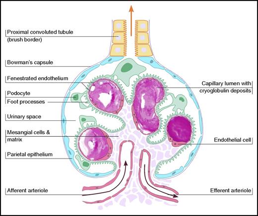 Figure 1. Schematic illustration of vascular occlusion in type I cryoglobulinemia, demonstrating glomerular intracapillary thrombi.