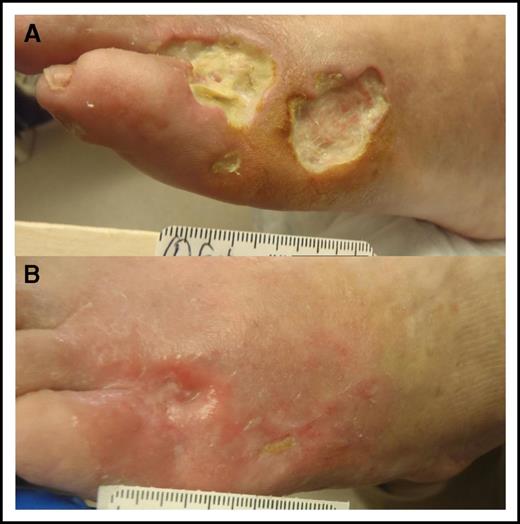 Figure 2. Skin necrosis in cryoglobulinemia. (A) Three skin ulcers at the anterolateral dorsum of the left foot in a patient with newly diagnosed WM-associated mixed cryoglobulinemia. Note that the 2 large ulcers are full skin thickness with minimal surrounding inflammatory response and no tendon or bone exposure. Prophylactic antibiotics were initiated to prevent serious infection. (B) The ulcers healed within 3 months from initiation of definitive therapy for WM.