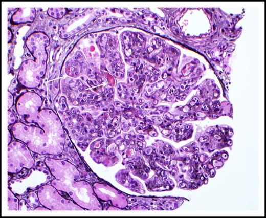 Figure 3. Cryoglobulinemic glomerulonephritis. The glomerulus shows global occlusion of peripheral capillary lumina by numerous infiltrating monocytes. Segmental intracapillary pink-staining immune thrombi (arrows), likely representing cryoglobulin deposits, are seen. There is widespread duplication of the glomerular basement membrane with associated cellular interposition (silver stain). Original magnification ×400. Photo courtesy of Samih Nasr, Mayo Clinic, Rochester, MN.