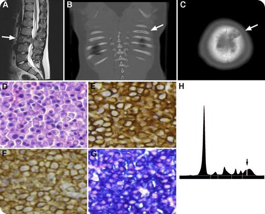 A 14-year-old boy presented with several months of progressive low back pain. Magnetic resonance imaging showed a destructive mass of the L3 vertebra (panel A). Computed tomography revealed lytic lesions in the left sixth (panel B) and eighth ribs, T12 and S2 vertebrae, and left parasagittal calvarium (panel C). Biopsy of L3 identified sheets of cells with an eccentric nucleus and prominent Golgi apparatus (panel D, hematoxylin and eosin stain, original magnification ×40); cells were positive for CD138 and CD56 (panel E, CD138 immunostain, original magnification ×40; panel F, CD56 immunostain, original magnification ×40), and negative for CD45 expression. In situ hybridization identified κ light-chain restriction (panel G, original magnification ×40). Cytogenetic analysis was negative. Bone marrow evaluation was normal. Additional workup identified a small serum monoclonal immunoglobulin A spike of κ light-chain type (panel H, arrow). Complete blood count, calcium, lactate dehydrogenase, hepatic, and renal function laboratory results were normal. Urine protein was negative and β2-microglobulin was normal. A diagnosis of multiple myeloma was made. The patient underwent emergent radiation to the L3 lesion due to progressive neurologic symptoms followed by systemic therapy resulting in resolution of the monoclonal spike and reduction of the L3 lesion. / Multiple myeloma is uncommon in the pediatric population, and prior cases suggest a milder clinical presentation vs that of adults. Nevertheless, it is part of the differential diagnosis of destructive bony lesions and appropriate workup will uncover it.