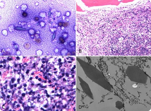 A 49-year-old man presented with a 3-month history of generalized body pain, 40-lb weight loss, night sweats, fevers, chills, and osteolytic lesions. Complete blood count showed anemia (hemoglobin of 7.5 g/dL); there was no eosinophilia. Bone marrow aspirate revealed blue-gray crystals (panel A; May-Grünwald-Giemsa stain, original magnification ×50). The biopsy revealed a cellular bone marrow with eosinophilic crystals and focal cell necrosis. Large crystals were visualized at higher magnification (panels B-C; hematoxylin and eosin stain, original magnifications ×10 and ×100, respectively). Immunohistochemical studies were negative for CD138, CD20, CD3, CD15, CD68, CD45, κ/λ chains, CD1A, CD79a, and CD38. Electron microscopy confirmed the bipyramidal structure longitudinally and in cross-section (panel D; original magnification ×74 500). Positron emission tomography/computed tomography revealed lymphadenopathy, and biopsy led to a diagnosis of T-cell lymphoblastic lymphoma. / These crystals are compatible with Charcot-Leyden crystals (CLCs), which are classically seen not only in the setting of eosinophilic inflammatory reactions but also in hematological malignancies in association with eosinophilia. CLCs have been described with bone marrow necrosis without eosinophilia in acute myelogenous leukemia but not previously in T-cell lymphoblastic lymphoma. This case emphasizes that the presence of CLCs in the setting of bone marrow necrosis can be associated with multiple hematologic malignancies.