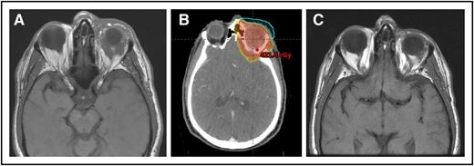 (A) A 64-year-old man with MZL of the left orbit. (B) An intensity-modulated RT plan of 24 Gy was designed, but only 4 Gy was delivered with near-CR obtained. (C) Seven months’ follow-up after only 4 Gy with no progression.