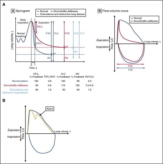 Figure 1. Representative flow volume. (A) Representative flow volume loop of a patient with BOS (red) compared with a patient with normal exhalation (gray) (left). Spirogram representation of BOS (red) as compared with normal lung volumes (gray) and those of a patient with sclerotic GVHD (blue) or extrapulmonary restriction (right). Within the spirogram, the FEV1 is shown first, then the FVC and RV, and then the TLC (TLC = RV + VC). Below the spirogram are representative PFT parameters for each of the 3 groups of patients: normal in gray, BOS in red, and sclerotic GVHD in blue. (B) Representative flow volume showing the notch characteristic of tracheomegaly or tracheobronchomalacia. Panel A reprinted from Williams et al10 with permission.