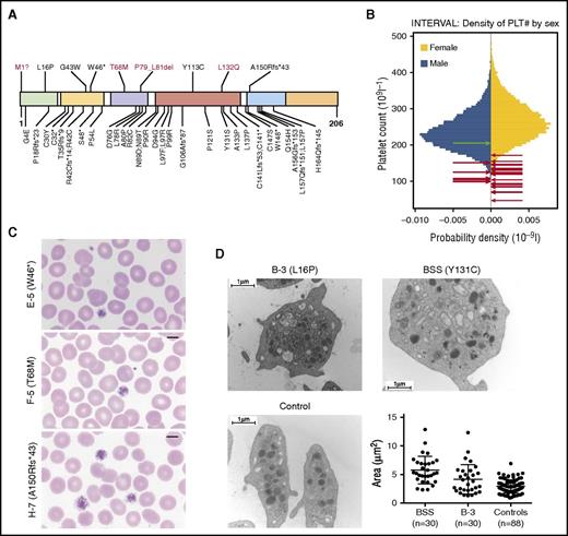 Figure 2. (A) Localization and consequence of the 9 distinct rare variants identified in GP1BB (shown above the diagram) in the context of all 39 variants published previously, excluding the 22q11.2 deletion. Novel variants are shown in red. Known variants were obtained from a recent review,8 2 publications on BSS published since the review,26,27 and an article reporting a single case with dominant macrothrombocytopenia possibly because of a heterozygous variant encoding R42C.12 The variant encoding T68M was observed in an unaffected relative of a patient with non-BPD rare disease for whom a complete blood count was unavailable. Only the variant encoding G43W is present (in 1 individual) in the ExAC database. The domains shown in colors, from left to right, are signal peptide (1–25), LRR N-terminal (27–55), LRR (60–83), LRR C-terminal (89–143), transmembrane domain (148–172), and cytoplasmic domain (173–206). (B) Gender-stratified histograms of platelet count measurements obtained using a Sysmex hematology analyzer from 48 345 blood donors from the INTERVAL randomized controlled trial28 after adjustment for technical artifacts. The red arrows superimposed on the histograms indicate the gender and values for patients with 1 of the variants in GP1BB reported herein. For individuals I-3 and L-3, with a range of platelet counts, the midpoints were used. The green arrow indicates the gender and value for individual E-1, who is homozygous for the wild-type allele. Any superimposed arrows have been nudged slightly along the vertical axis so they can be distinguished. (C) Images of blood films from cases E-5, F-5, and H-7, with different variants in GP1BB (encoding W46*, T68M, and A150Rfs*43). Original magnification, ×100; May-Grünwald-Giemsa stain. (D) Images show representative electron micrographs of platelets from patient B-3, a patient with BSS (homozygous for a variant encoding Y131C) and an unaffected control, whereas the dot plot shows area measurements of 30 randomly selected platelets from a patient with BSS, 30 from case B-3, and 88 from 3 controls (30+30+28 platelets) with similar distributions. There was a significant difference among the means of the 3 groups (P < .0001, one-way analysis of variance). There was a significant difference between the mean area of platelets from the BSS case and patient B-3 (P = .0021), between the BSS case and controls (P < .0001), and between B-3 and controls (P = .004; Tukey’s method for multiple comparisons).