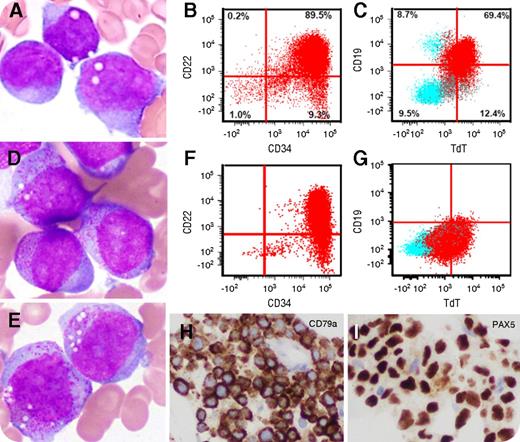 A 63-year-old woman had a history of B-cell acute lymphoblastic leukemia (B-ALL). The pretreatment blasts showed no significant cytoplasmic granules (panel A; original magnification ×1000, Wright-Giemsa stained marrow aspirate smears) and were positive for CD19, CD22, CD10, CD34, and terminal deoxynucleotidyltransferase (TdT) (partial) (panels B-C) and negative for myeloperoxidase (MPO). She relapsed and received blinatumomab. A recent bone marrow biopsy revealed blasts with abundant cytoplasmic granules (panels D-E; original magnification ×1000, Wright-Giemsa stained marrow aspirate smears), raising the differential diagnosis of acute myeloid leukemia (AML). The blasts were positive for CD22, CD10, CD34, and TdT (partial) (panels F-G) and negative for MPO, an immunophenotype exactly the same as pretreatment blasts except without CD19 expression, which was the result of blinatumomab (anti-CD19 antibody) treatment. The blasts were negative for MPO and nonspecific esterase by cytochemistry and positive for CD79a and PAX5 by immunohistochemistry (panels H-I; original magnification ×400, immunohistochemical stain), which further confirmed relapsed B-ALL. / One of the main morphologic features distinguishing AML from ALL is cytoplasmic granules in blasts. In ALL, the blasts usually lack cytoplasmic granules. However, ALL may present with significant cytoplasmic granules in blasts (so-called granular ALL), which usually occurs in children (2%-7%) but is extremely rare in adults. This case demonstrates that morphology can shift after treatment, and it is critical to perform immunophenotypic analysis in relapsed leukemia to reach the correct diagnosis.