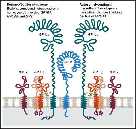 Schematic drawing of the GPIb-IX-V complex showing GP1bα, GPIbβ, GPIX, and GPV subunits that constitute the complex on platelet surface. Biallelic variants in GP1BA, GP1BB, and GP9 result in Bernard-Soulier syndrome. Monoallelic variants in GP1BA and GP1BB are associated with isolated macrothrombocytopenia. Figure reproduced with modifications from Luo et al2 with permission. P, phosphorylation sites. Professional illustration by Patrick Lane, ScEYEnce Studios.
