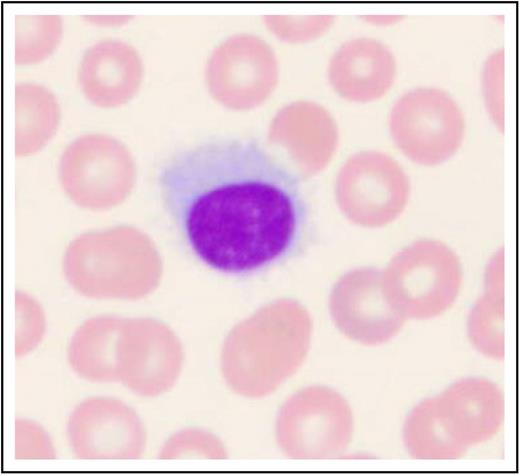 Figure 1. Histologic image of a hairy cell. Wright-Giemsa stained smear of peripheral blood. This image was obtained by using a UPlanFL 100 Olympus objective oil immersion lens. The image was obtained by using an MTI 3 CCD camera (DAGE-MTI Inc.) with PAX-it 2.0 acquisition software (MIS).