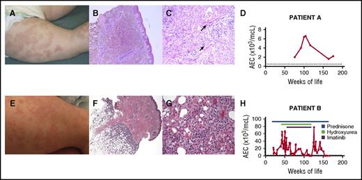 Figure 1. Clinical and laboratory findings in 2 children with a somatic gain-of-function mutation in STAT5b. The urticarial skin rash (A and E), underlying histological features (B, C, F, and G), and absolute eosinophil count (AEC) over time (D and H) are shown for both children. Photomicrographs show a perivascular lymphocytic infiltrate (B; original magnification ×5, hematoxylin and eosin stain) with edema and scattered eosinophils (C; original magnification ×20, hematoxylin and eosin stain) and a deep subcutaneous lymphohistiocytic infiltrate involving the lobules consistent with a lobular panniculitis (F; original magnification ×4, hematoxylin and eosin stain) with no evidence of rimming of the lymphocytes and scattered eosinophils at high power (G; original magnification ×40, hematoxylin and eosin stain). Arrows indicate representative eosinophils. The upper limit of the normal range for AEC is indicated by a dashed line.