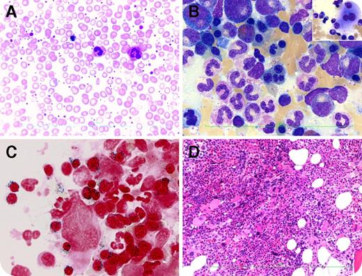 A 75-year-old man was investigated for persistent thrombocytosis/leukocytosis. He had history of night sweats and chronic anemia, but no thrombotic events. He had no splenomegaly and lactate dehydrogenase was persistently elevated (380 U/L). Complete blood count showed: leukocytes, 14.58 × 109/L; hemoglobin, 113 g/L; mean corpuscular volume, 82.3 fL; and platelets, 1203 × 109/L. Peripheral blood smear showed a leukoerythroblastic reaction with marked thrombocytosis (panel A; original magnification ×60, Wright's stain). Marrow aspirate was hypercellular with 1% blasts, megakaryocytic proliferation and atypia including dysmegakaryopoiesis (panel B inset; original magnification ×100 oil immersion, Wright-Giemsa stain), granulocytic hyperplasia, and megaloblastic erythropoiesis with dysplasia (panel B; original magnification ×100 oil immersion, Wright-Giemsa stain). The iron stain showed 40% ring sideroblasts (panel C; original magnification ×100 oil immersion, Perls' stain). Biopsy was consistent with prefibrotic/early primary myelofibrosis (prePMF) with increased abnormal megakaryocytes (panel D; original magnification ×40, hematoxylin and eosin stain) and MF-1 reticulin fibrosis. JAK2-V617F mutation was present. Cytogenetics was normal. A diagnosis of myelodysplastic/myeloproliferative neoplasms with ring sideroblasts and thrombocytosis (MDS/MPN-RS-T) was rendered per 2016 World Health Organization revision, although the patient qualified for 2 major and 3 minor criteria for prePMF. / MDS/MPN-RS-T was previously known as refractory anemia with ring sideroblasts associated with marked thrombocytosis. About 90% of patients have a SF3B1 mutation (not tested in this case). It can have both clinical/pathological features of BCR-ABL1− MPN including prePMF and requires vigilant searching for dysplasia and ring sideroblasts.