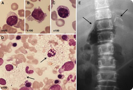 A 21-year-old man had presented at 3 months of age with failure to thrive, malabsorption, diarrhea, weight loss, ascites, and hepatosplenomegaly. A diagnosis of Wolman disease (lysosomal acid esterase deficiency) was made following demonstration of excess cholesterol ester in the bone marrow, liver, and jejunal mucosa. Enzyme studies confirmed severe deficiency of lysosomal acid esterase and heterozygous levels in the parents. Parents were nonconsanguineous; a brother had died of the same disease in infancy, and 1 brother was unaffected. Despite severe malabsorption, the patient unusually survived into adulthood on a low-fat diet, vitamin supplements, exogenous cholesterol, clofibrate, and parenteral nutrition. Peripheral blood showed macrocytic anemia with mild neutropenia, thrombocytopenia, and acanthocytes. Approximately 20% of lymphocytes demonstrated between 1 and 7 cytoplasmic vacuoles (panels A-C; May–Grünwald–Giemsa stain). Marrow aspirate showed numerous abnormal foamy macrophages (panel D, arrows; May–Grünwald–Giemsa stain) that were also positive with oil red O and Cain’s Nile blue, confirming cholesteryl ester storage substances. Abdominal radiography demonstrated characteristic bilateral adrenal calcification (panel E, arrows). / Lymphocyte vacuolation may be acquired but is a useful morphological feature to refine the differential diagnosis of abnormal storage cells associated with neurovisceral disease, being absent in Niemann-Pick type C, Gaucher disease, and GM1 gangliosidosis type 2.