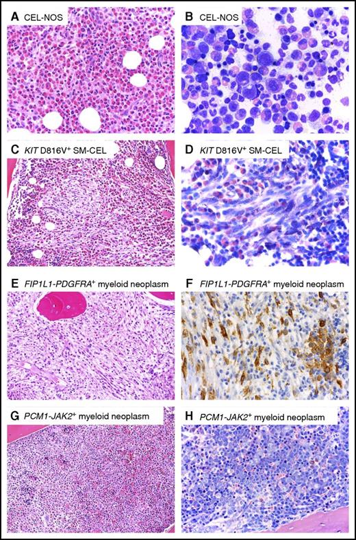 Figure 2. Representative BM histomorphology of different myeloid neoplasms with eosinophilia. (A-B) CEL, NOS. (A) Hematoxylin and eosin (H&E). Histology of the BM shows an extremely hypercellular marrow with packed infiltrates of eosinophils. Normal blood cell precursors are absent. (B) Wright-Giemsa. Cytomorphological aspects on a BM smear also exhibit an abundance of eosinophils at all stages of maturation. Note that significant cellular atypia is absent. (C-D) KIT D816V-positive systemic mastocytosis with associated chronic eosinophilic leukemia (SM-CEL). (C) H&E. BM histology reveals a markedly hypercellular marrow with a massive increase in eosinophils. Centrally located in the marrow space, a compact infiltrate consisting of pale, mostly spindle-shaped cells is easily detected (left). (D) Higher magnification and Wright-Giemsa stain reveals that the spindle-shaped cells contain metachromatic granules, although in lesser number than normal mast cells. The presence of compact infiltrates mainly consisting of spindle-shaped cells allows prompt diagnosis of a systemic mastocytosis. (E-F) FIP1L1-PDGFRA-positive myeloid neoplasm. (E) H&E-stained BM shows massive hypercellularity with increase in eosinophils, which form narrow rows as an indirect sign of fibrosis. Normal blood cell precursors, in particular megakaryocytes, are missing. (F) ABC method. Anti-CD117 immunohistochemistry reveals an increase in spindle-shaped, mostly loosely scattered mast cells, with expression of CD117 (KIT). Note a small cohesive group of round mast cells on the right not sufficient for a diagnosis of systemic mastocytosis to be established. Mast cells display aberrant expression of CD25 (not depicted), which is seen outside the setting of mastocytosis only in FIP1L1-PDGFRA-positive myeloid neoplasms. (G-H) PCM1-JAK2-positive myeloid neoplasm. (G) H&E. (H) Wright-Giemsa. Extremely hypercellular BM with subtotal depletion of fat cells and massive increase in erythroblasts forming irregular giant erythra filling whole marrow spaces, and thus exceeding the size seen in any other myeloid neoplasm or reactive states. Images courtesy of Professor Hans-Peter Horny.
