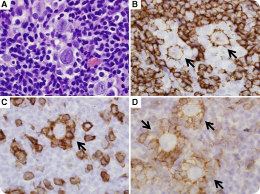 A 35-year-old man presented with axillary adenopathy. A biopsy was performed. Microscopic evaluation demonstrated a nodular lymphoid proliferation composed of scattered large atypical lymphoid cells in a background of small mature lymphocytes. Many of the atypical cells had multilobulated nuclei and others had large, rounded nuclei with multiple nucleoli. The large cells were very tightly ringed by smaller lymphocytes forming rosettes (panel A; original magnification ×1000, hematoxylin and eosin stain). The large cells and the majority of small background lymphocytes were CD20 positive (arrows, panel B; original magnification ×1000, CD20 immunostain). However, the small lymphocytes ringing the large cells were distinctly CD20 negative (panel B). These lymphocytes expressed CD3 (arrow, panel C; original magnification ×1000, CD3 immunostain), programmed cell death protein-1 (arrows, panel D; original magnification ×1000, PD-1 immunostain), and CD57, consistent with follicular helper T (TFH) cells. Additional studies showed that the tumor cells expressed PAX5 and BCL6 but were negative for CD30, CD15, and Epstein-Barr virus. A diagnosis of nodular lymphocyte–predominant Hodgkin lymphoma (NLPHL) was made. / A characteristic finding in NLPHL is TFH cells tightly ringing tumor cells. TFH cells are speculated to have a prosurvival effect in this context, perhaps analogous to their role in the normal follicle center where they promote survival of positively selected B cells. This feature highlights the immunologic interplay in the microenvironment.
