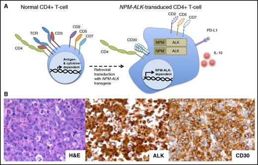Figure 2. The NPM-ALK transgene can transform normal human CD4+ peripheral T-cells into ALCL. (A) NPM-ALK–transduced normal CD4+ peripheral T cells become immortalized and acquire morphology and surface phenotype of ALCL, including expression of CD30, PD-L1, and IL-10, at least partial loss of the TCR, CD2, CD5, and CD5, and maintenance of CD4. (B) Histologic examination of the tumors formed by the NPM-ALK–transformed CD4+ T cells xenotransplanted into nonobese diabetic/severe combined immunodeficient γ mice reveals their striking and immunophenotypic resemblance to the primary, patient-derived ALK+ ALCL. H&E, hematoxylin and eosin.