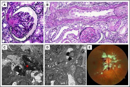 Figure 1. Renal biopsy findings and retinal fundus photograph from patients following IV abuse of extended-release oxymorphone tablets. (A) TMA involving the arteriole with fibrinoid necrosis, extending into the vascular pole of the glomerulus (Jones silver stain, original magnification ×200). (B) Large artery showing endothelial swelling and partial lumen occlusion, with congested glomerulus below (Jones silver stain, original magnification ×100). (C) Fibrin tactoids (red asterisk) underneath swollen endothelium with overlying podocyte foot process effacement, without immune complex deposition (transmission electron microscopy, original magnification ×7100). (D) Swollen endothelium nearly occluding capillary lumen, with RBC fragments (dark black material) and overlying podocyte foot process effacement, without immune complexes. Clear vacuolated areas (black arrow) are found in endothelium and other cells, possibly representing particulate matter from adulterated tablets (transmission electron microscopy, original magnification ×2800). (E) Retinal fundus photograph in a patient experiencing loss of vision following IV abuse of extended-release oxymorphone, demonstrating numerous cotton-wool spots and microhemorrhages.