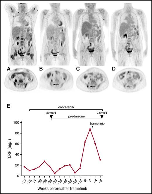 Figure 1. Therapeutic efficacy assessed by FDG-PET/CT scans and serum CRP levels. Coronal and axial FDG-PET/CT images (A) before dabrafenib, (B) best response under dabrafenib, (C) recurrent disease under dabrafenib, and (D) under dual combined dabrafenib/trametinib treatment. Note the bone marrow response under dabrafenib with focal recurrence in the iliac bone (arrow). (E) Longitudinal CRP levels before and after initiation of dabrafenib/trametinib treatment. Prednisone therapy was initiated at 20 mg per day and rapidly tapered to a dose of 2.5 mg per day.