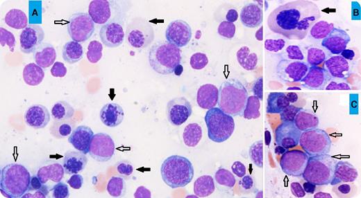 A 69-year-old man presented with increasing fatigue over 3 months. The blood work showed pancytopenia (white blood cell count, 2.6 × 109/L; hemoglobin, 5.3 g/dL; and platelet count, 17 × 109/L). A bone marrow aspirate showed hypercellular marrow with erythroid predominance (60%), trilineage dysplasia including marked dyserythropoiesis (megaloblastoid maturation, karyorrhexis, and nuclear budding; black arrows, panels A-B; for all panels, original magnification ×40, May-Grünwald stain), and 15% blasts of all marrow nucleated cells (white arrows, panels A,C), but 38% blasts of the nonerythroid cells. The flow cytometry study showed that the blasts were positive for CD34, CD117, HLA-DR, CD13, CD33, CD7, and myeloperoxidase, and negative for other lymphoid-associated markers, consistent with myeloid blasts. The conventional cytogenetic analysis revealed a complex abnormal karyotype: 46,XY, del(5)(q13q31), −7, add(11)(p15), −18, −20. / Due to the presence of ≥20% blasts in the nonerythroid cell population, this would be classified as acute erythroid leukemia (AEL; erythroid/myeloid) according to the 2008 World Health Organization (WHO) classification. However, it should now be classified as myelodysplastic syndrome (MDS) with excess blasts-2 based on the 2016 revised WHO classification. Recent studies suggest that the previously named AEL had a closer relationship to MDS than de novo acute myeloid leukemia in terms of morphologic and genetic features.