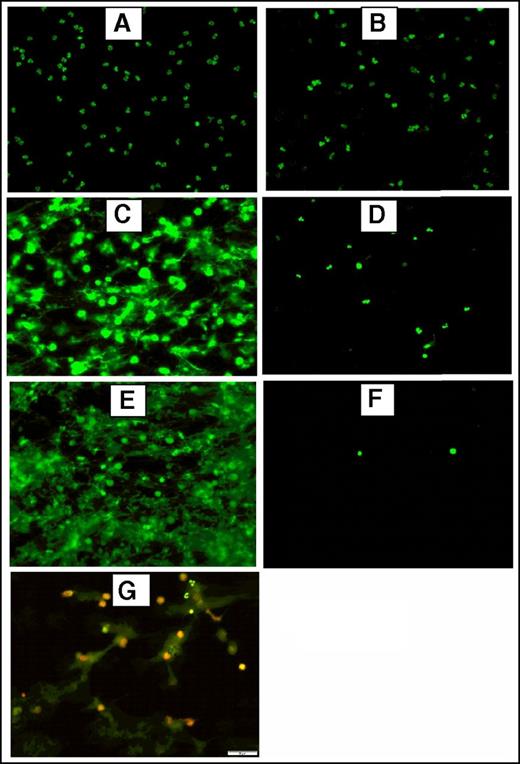 Figure 1. Fluorescence and immunofluorescence microscopy of stimulated human neutrophils for NETs formation. Stimulated normal human neutrophils were seeded on poly-l-lysine–coated slides and incubated at 37°C + 5% CO2 for 3 hours. After incubation, the preparations were fixed using 4% paraformaldehyde and stained using 2.5 μM Sytox Green, a DNA staining dye. Unstimulated neutrophils did not form NETs (A) and were intact after treatment with DNAase (20 μM) (B). Robust NET release after stimulation with 600 nM PMA (C) or 5 μM A23187 (E) as shown by the bright and scattered Sytox Green signal pattern. Digestion of PMA-stimulated (D) and A23187-stimulated (F) NETs after treatment with DNAase (20 μg/mL), indicating the extracellular location of NETs. (G) Dual immunofluorescence staining of NETs by Sytox Green (2.5 μM) for DNA and citrillunated histone H3 (red). A23187, calcium ionophore.