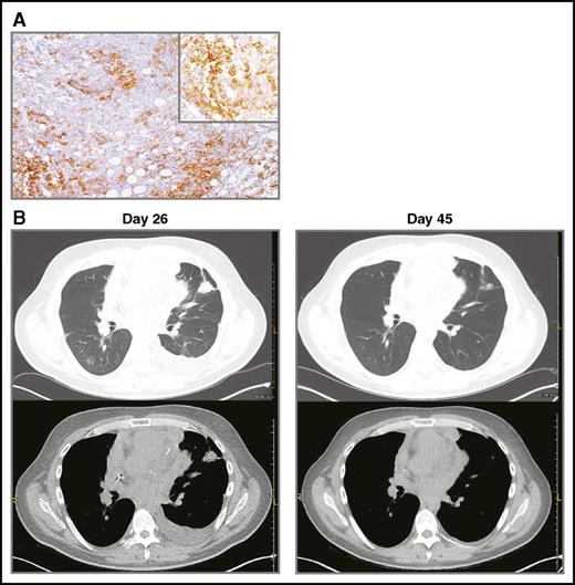Figure 1. PD-L1 immunhistochemistry and CT scans demonstrating clinical response to therapy. (A) PD-L1 (CD274) expression by the patient’s DLBCL cells. Biopsy was obtained prior to CART19 cell infusion. Immunohistochemical staining with an anti-PD-L1 antibody from Cell Signaling (clone E1J2J, catalog number 15165BF). The main image is at ×40 magnification; the upper-right corner inset at ×100. Microscope: Leica DM 2500, lens ×10. Camera: Leica, MC 170 HD. Acquisition software: LAS V4.8. (B) CT imaging on day of pembrolizumab infusion (day 26) and 3 weeks after pembrolizumab infusion (day 45).