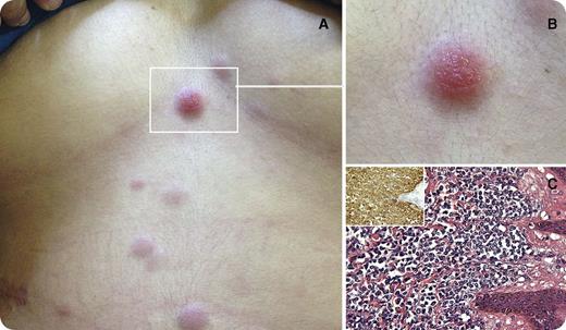 A 27-year-old woman presented with dermal nodules on the scalp, abdomen (panels A-B), breast, and genitalia. An abdominal skin biopsy showed a population of immature cells (panel C; original magnification ×100; hematoxylin and eosin stain) positive for CD45/LCA, CD43, CD68 (panel C inset; original magnification ×100; immunoperoxidase stain), CD163, myeloperoxidase (focal), and Ki-67 (∼60%) and negative for other markers tested, supporting the diagnosis of myeloid sarcoma. Complete blood count and bone marrow examination subsequently showed acute monoblastic leukemia; conventional cytogenetics were normal and NPM1 mutation was present. The patient received chemotherapy and underwent complete remission. / Myeloid sarcoma is a tumor mass of myeloid cells that involves an extramedullary site. The clinical history in patients with myeloid sarcoma is highly variable. Most often, myeloid sarcoma occurs in patients with simultaneous bone marrow involvement or as a relapse of acute myeloid leukemia. Myeloid sarcoma can occur as blastic transformation in patients with a myelodysplastic syndrome (MDS), myeloproliferative neoplasm (MPN), or MDS/MPN. Myeloid sarcoma also may develop in cancer patients treated previously with chemotherapy and in this context might be secondary to therapy. In a minority of patients, myeloid sarcoma can be an initial manifestation of disease. Myeloid sarcoma can appear at any age and involve virtually any anatomic site.