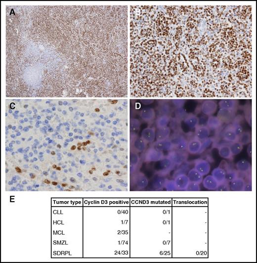 Figure 2. Cyclin D3 in splenic B‐cell lymphomas. (A-B) 3,3′-diaminobenzidine (DAB) immunostaining of a cyclin D3-positive SDRPL case. Original magnification ×4 (A) and ×20 (B). (C) DAB immunostaining of a cyclin D3‐negative SMZL case. Original magnification ×40. (D) FISH staining with a cyclin D3 break-apart probe. DNA nuclei were stained with 4′,6-diamidino-2-phenylindole. Original magnification ×100. (E) Number of splenic B-cell lymphoma cases studied by cyclin D3 immunohistochemistry, CCND3 sequencing, and FISH analysis.