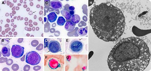 A 17-year-old girl with a history of hypoplastic anemia that required transfusions twice resolved during infancy presented with fatigue and muscle pain with exertion. A complete blood count revealed normocytic anemia (hemoglobin, 10.0 g/dL) and leukopenia (white blood cell count, 3.22 × 109/L). A blood smear demonstrated anisopoikilocytosis with occasional Pappenheimer bodies (panel A; original magnification ×1000, Wright-Giemsa stain). Bone marrow aspirate (panels B-C; original magnification ×1000, Wright-Giemsa stain) showed erythroid maturation with occasional periodic acid–Schiff-negative cytoplasmic vacuoles (panels D-E; original magnification ×1000, Wright-Giemsa stain) and Pappenheimer bodies in red blood cells (panel B). An iron stain showed many ring sideroblasts (panels F-G; original magnification ×1000, Prussian blue stain for iron). Electron microscopy illustrated numerous cytoplasmic vacuoles in normoblasts (panel H; original magnification ×4500). Flow cytometric and cytogenetic studies were normal. Biochemical studies showed normal pancreatic elastase, vitamins B6 and B12, zinc, copper, and lead with increased lactic acid (2.6 mmol/L). Congenital sideroblastic anemia gene sequencing identified double heterozygous mutations of the YARS2 gene (c.933 C>G and c.731 G>C). This patient was diagnosed with myopathy, lactic acidosis, and sideroblastic anemia 2 (MLASA2). / MLASA2, a hereditary syndromic sideroblastic anemia, is associated with mutations of YARS2, a gene encoding the mitochondrial tyrosyl-tRNA synthetase. We present a case of MLASA2 with cytologic and ultrastructural features similar to those of Pearson syndrome. Nonhereditary causes of sideroblastic anemia in children include drug or toxin exposure or, rarely, myelodysplastic syndrome. A morphologic examination, combined with clinical, biochemical, and molecular studies, is essential to obtain the diagnosis.