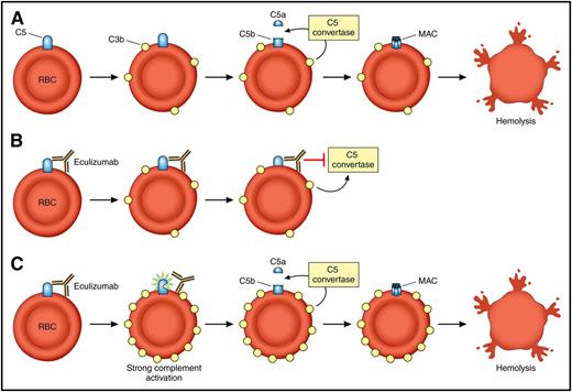 Model of eculizumab function and breakthrough hemolysis in the setting of strong complement activation. (A) In PNH, loss of CD59 and CD55 results in C3b priming of C5 on red cells and allows for cleavage of C5 into C5a and C5b. This leads to formation of the MAC on PNH red cells and results in intravascular hemolysis. (B) The patient with PNH on eculizumab. Eculizumab binds to C5, and through steric hindrance, inhibits the ability of the C5 convertase to cleave C5 into C5a and C5b. The MAC does not form, and the red cell is protected. (C) The patient with PNH on eculizumab in the setting of strong complement activation (infection, surgery, etc) experiences accumulation of C3b on the cell surface (strong activation). This results in a conformation change in C5 that disrupts the steric hindrance induced by eculizumab and leads to breakthrough intravascular hemolysis. RBC, red blood cell. Professional illustration by Patrick Lane, ScEYEnce Studios.