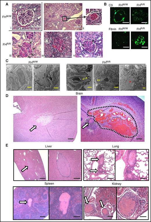 Figure 3. Light, immunofluorescence, and electron microscopy of kidney and other pathology in FH W1206R mutant mice. (A) PAS staining of kidney sections. (i) A normal-looking FHW/W mouse glomerulus. (ii-v) Representative FHR/R mouse kidney sections (from 30 mice analyzed) showed features of aHUS, including arteriolar thrombosis (ii, black square), capillary wall thickening and double contours in glomeruli (iii, white arrows), afferent arteriolar thrombosis in arteriole (iv, yellow asterisk), and expanded matrix and microthrombi in capillary lumen (v, blue arrows). Scale bars represent 25 μm (i-ii, left; iii-v) and 50 μm (ii, right). (B) Immunofluorescence staining of C3 and fibrin or fibrinogen. C3 staining was restricted to the Bowman’s capsule only in FHW/W mice, whereas weak C3 staining of a granular pattern was observed in the glomerulus of FHR/R mice. Strong fibrin and fibrinogen staining of a diffuse pattern was detected both in capillaries and in mesangial lesions of FHR/R mouse glomeruli, but not in FHW/W mouse glomeruli. Scale bar, 25 μm. (C) Electron microscopy of kidneys. A FHW/W mouse (15-week-old female, 1 of 2 WT mice analyzed by electron microscopy) kidney showed normal basement membrane and foot processes. In a representative FHR/R mouse (15-week-old female, 1 of 4 mutant mice analyzed by electron microscopy) kidney, the glomerular capillary wall showed subendothelial expansion with fluffy granular material (yellow arrow) and mesangiolysis with rarefaction of mesangial matrix (red asterisk), with no electron-dense deposits. Scale bars represent 2 μm (FHW/W, left, and FHR/R) and 500 nm (FHW/W, right). (D) hematoxylin and eosin staining of brain sections from a representative FHR/R mouse with neurological abnormalities. Ischemic changes (arrow, left panel), thrombus formation (arrow, right panel) or intracerebral hemorrhage (area circled by dotted line) were observed. Scale bar, 25 μm. (E) Hematoxylin and eosin staining of liver, lung, spleen, and kidney sections from representative FHR/R mice showed thrombi (arrows) in large blood vessels. Scale bars represent 25 μm (left panel of each organ) and 50 μm (right panel of each organ).