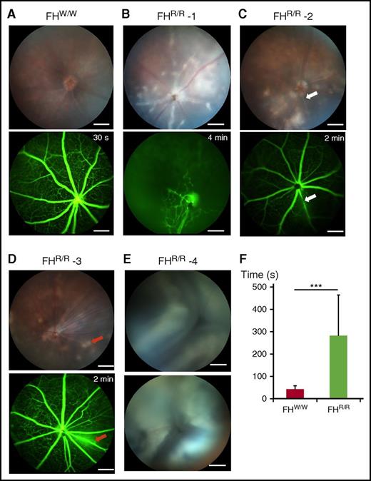 Figure 4. Retinopathy in FH W1206R mutant mice. (A) A 5-week-old male FHW/W mouse showed normal appearance of retina on funduscopy and rapid dye distribution across retinal blood vessels (<30 seconds) on fluorescein angiography. (B) A 10-week-old male FHR/R mouse exhibited retinal whitening and cotton wool spots by funduscopy and widespread nonperfusion of retinal vasculature, with dilation of the few perfused vessels by fluorescein angiography. This appearance is consistent with a central retinal artery occlusion with limited perfusion provided by a cilioretinal artery. (C) A 5-week-old FHR/R mouse showed retinal whitening by funduscopy and stenosis of vessel (white arrow) by fluorescein angiography. (D) A 10-week-old FHR/R mouse exhibited multiple hypopigmented spots on funduscopy and dye leakage (red arrows) by fluorescein angiography. (E) A 5-week-old male FHR/R mouse had detached retina in both eyes by funduscopy. (F) Time lapse analysis of the arteriovenous phase in fluorescein angiography shows delayed perfusion of retinal blood vessels in FHR/R mice (n = 21) compared with FHW/W mice (n = 10). Data are presented mean ± SD. ***P < .001 (Student t test). In panels B-E, the time label on fluorescein angiography designates the time point at which the picture was taken after dye injection. Scale bars, 200 μm.