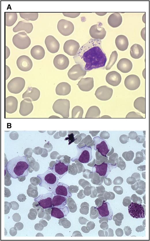Figure 1. LGLs on blood and marrow smears. (A) A typical LGL on blood smear. (Wright-Giemsa stain: original magnification ×1000; Caméra RETIGA 2000). (B) BM smear showing numerous LGL with a basophilic neutrophil. (Wright-Giemsa stain: original magnification ×1000; Caméra RETIGA 2000). Image courtesy of Beatrice Ly-Sunnaram (Rennes University Hospital, Rennes, France).