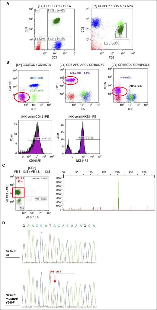 Figure 2. FCM and TCR γ gene rearrangement analysis in LGL leukemia. (A) FCM analysis of a typical case of T CD3+ LGL leukemia showing CD3+/CD5dim/CD8+ (dark green). (B) FCM analysis of a case of NK CD3− LGL leukemia showing a CD3−/CD8−/CD16+/CD56+ phenotype (pink). KIR monotypic expression using CD161 and NkB1. (C) Clonality assessment: specific Vβ mAbs showing restricted expression of Vβ13.1 >90% (left); detection of clonal TCR γ gene recombination by gene scanning analysis, showing single peak in green (right). (D) Stat 3 mutation detection in a case of T-LGL leukemia using Sanger sequencing. FCM, flow cytometry; WT, wild-type.