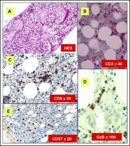 Figure 4. BM features of LGL leukemia. (A) Hematoxylin and eosin staining (HES) of marrow biopsy reveals a slightly hypercellular marrow with a subtle increase in interstitial lymphocytes. (B) CD3 staining reveals the LGL interstitial infiltration. (C) Immunoperoxydase staining for CD8 demonstrates clusters of at least 8 cytotoxic lymphocytes CD8+. (D) Linear array of intravascular LGL demonstrated by Granzyme B (GzB) staining. (E) CD57 staining reveals the LGL interstitial infiltration. Original magnifications ×4 (A), ×40 (B), ×20 (C), ×100 (D), and ×20 (E). Images courtesy of Philippe Gaulard (Department of Pathology, Henri Mondor Hospital, Assistance Publique–Hôpitaux de Paris, Creteil, France) and Patrick Tas (Department of Pathology, Rennes University Hospital, Rennes, France).