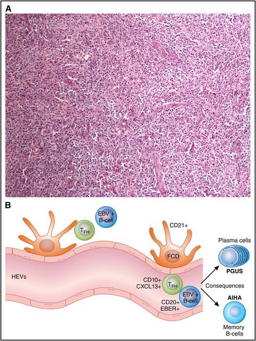 Figure 1. Architecture, immunophenotype, and consequences of AITL. (A) Lymph node effacement devoid of follicles with characteristic CXCL13+ T cells. (B) An illustration of the cellular components of the microenvironment and immunophenotype in AITL including HEVs, EBV+ B cells, and TFH. The B-cell activation leads to consequences commonly of AIHA and hypergammaglobulinemia (PGUS).