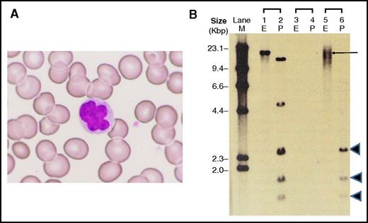 Figure 1. Donor-derived abnormal lymphocytes after haplo-PBSCT. (A) Three years after haplo-PBSCT, donor-derived lymphocytes with nuclear abnormalities, such as lobulation, were observed in peripheral blood of the patient (recipient); Wright-Giemsa staining, original magnification ×400. (B) HTLV-I Southern blot analysis of donor-derived abnormal lymphocytes, digested by EcoRI (E) and PstI (P). Lanes 1 and 2, positive control; lanes 3 and 4, negative control; lanes 5 and 6, the patient’s (recipient’s) sample. M, size marker.