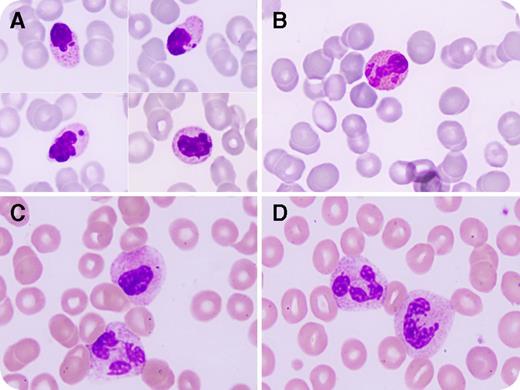 A previously healthy 45-year-old woman presented with severe abdominal pain, diarrhea, and vomiting persisting 12 hours after ingestion of a homemade vegetable juice. Seventy-two hours later, she developed hemiparesis and multiple organ failure with renal and hepatic insufficiency, leading to encephalopathy and coma. Laboratory analysis showed pancytopenia (white blood cell count, 1.2 × 109/L; neutrophils, 1.0 × 109/L; hemoglobin, 11.5 g/dL; and platelets, 32 × 109/L). A peripheral blood smear showed neutrophils and eosinophils of markedly reduced size with loss of segmentation, condensed chromatin, and nuclear fragmentation, whereas the cytoplasm was granular and often exhibited large inclusions (panels A-B; original magnification ×1000, May-Grünwald Giemsa stain). / The patient’s history and drug screening disclosed colchicine intoxication following the accidental ingestion of 200 mL of juice made of 40 pressed Colchicum autumnale leaves, which were mistaken for wild garlic plant (Allium ursinum). Twenty-four hours later, the serum level of colchicine was 12.15 μg/L (lethal dose, 9-24 μg/L). The morphologic anomalies in the neutrophils and eosinophils were most likely due to colchicine, which inhibits microtubule polymerization and triggers cell apoptosis. Two months later, most neutrophils had a normal morphology, with rare cells still showing pseudo–Pelger-Huët anomalies (panels C-D; original magnification ×1000, May-Grünwald Giemsa stain). Colchicine intoxication should be considered in patients who exhibit reduced-size neutrophils and condensed chromatin.