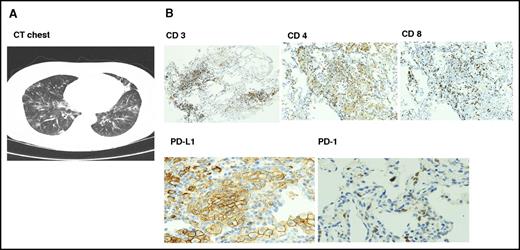 Figure 1. Radiologic and pathologic findings in autoimmune pneumonitis. (A) Computed tomographic scan findings were nonspecific with multifocal ground glass opacities. (B) Transbronchial biopsy showed immune peroxidase staining of lymphocytic infiltrate with reversal of CD4/8 ratio and upregulation of PD-L1 on type I pneumocytes with absent PD-1 expression. Original magnification ×100 (CD 3, 4, and 8) and ×200 (PD-L1 and PD-1).