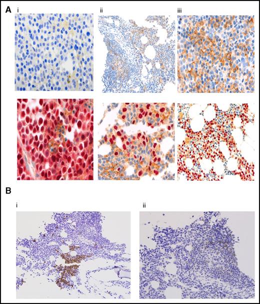 Figure 4. Correlative studies. (A) PD-L1 expression by immunohistochemistry in myeloma cells. Results are reported as percentage of myeloma cells showing membranous staining for PD-L1 (proportion score). Shown are BM samples with a proportion score of <1% (i), 1% to 49% (ii), and >50% (iii). The lower panels show corresponding MUM1 stain. PD-L1 stain is shown by the presence of brown chromogen, and the red color is MUM1 stain for myeloma cells. (B) CD3 and PD-1 expression by immunohistochemistry on T lymphocytes. CD3 staining (i) and PD-1 staining (ii). BM infiltrating T lymphocytes were graded as negative (<5% CD3, <1% PD-1) or positive (≥5% CD3, ≥1% PD-1). Original magnifications ×100 (Aii, upper panel; Aiii, lower panel; and Bi-ii), ×200 (Ai-ii, upper panels), and ×400 (Ai-ii, lower panels).