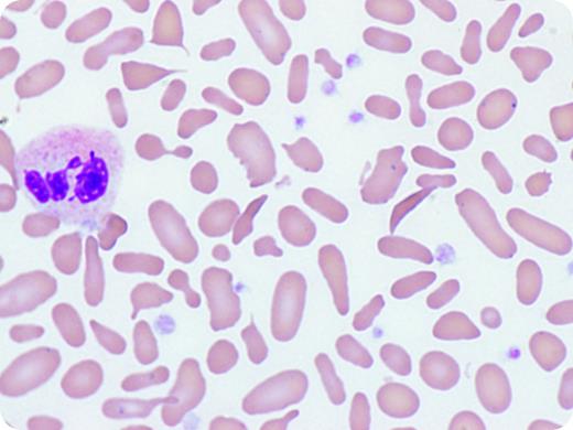 A 53-year-old asymptomatic African American man was evaluated for a lifelong history of anemia and thrombocytosis resulting from a splenectomy performed in childhood for unknown reasons. His complete blood count showed red blood cells, 5.79 × 106/μL; hemoglobin, 10.5 g/dL; mean corpuscular volume, 55.8 fL; and platelets, 878 × 109/L. Iron studies were normal. Hemoglobin electrophoresis showed hemoglobin A (56%), elevated hemoglobin A2 (3.9%), hemoglobin S (39.4%), and hemoglobin F (0.7%). These findings support β-thalassemia with hemoglobin S trait. The peripheral smear red blood cell count showed marked anisopoikilocytosis with elliptocytes (>30%), dacrocytes, sickle cells, and Howell-Jolley bodies (Wright-Giemsa stain; original magnification ×100, oil immersion). A bone marrow biopsy was performed, which revealed normal morphology and cytogenetics, ruling out a myeloproliferative disorder. The patient's father had hemoglobin S trait, but there is no other history of hemoglobinopathy. / The smear findings illustrated are highly unusual for hemoglobin S trait and β+ thalassemia, which would have mild microcytic anemia (mean corpuscular volume, 70-80 fL) with increased target cells and rare sickle cells. In this case, anisopoikilocytosis was prominent, including >30% elliptocytes. This is diagnostic of a red cell membrane defect, such as hereditary elliptocytosis. The morphology revealed the probable cause for the remote splenectomy and provides important information for family members.