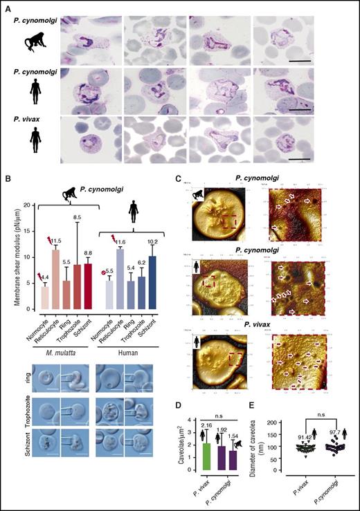 Figure 3. Comparative morphological and rheological characteristics of P cynomolgi and P vivax infected RBCs. (A) The morphologic similarity of P cynomolgi early trophozoites (18-24 hours after invasion) in M mulatta normocytes and human reticulocytes compared with that of P vivax in human reticulocytes. Giemsa-stained thin film smear is the most commonly used method for species diagnosis in areas where P vivax and P cynomolgi are co-endemic. Scale bar = 10 μm. (B) The effect of P cynomolgi invasion and development on the deformability of monkey and human RBCs. The plot shows the membrane mean shear modulus (SM) (a higher SM indicates a reduced membrane deformability) for different RBC types (monkey and human) and stages of P vivax erythrocytic development (geometric mean ± 95% confidence intervals; n > 15 cells from 3 independent trials). The red lightning icons indicate the tropism of P cynomolgi when invading human or monkey RBCs. Pictures of respective cell types before and during membrane SM measurement by micropipette aspiration are shown under the graph. Mean (geometric) SMs were compared by using ANOVA (Bonferroni correction) and multiple comparison test (Tukey). Uninfected normocytes were significantly more deformable than uninfected reticulocytes (P < .001). However, both ring and trophozoite P vivax stages become progressively more deformable (P < .05) until schizont stage (the very mature schizonts segmenters were especially rigid). Scale bar = 5 μm. (C) Comparative phenotypic characterization of caveolae in P cynomolgi- and P vivax–infected RBCs in monkeys and humans as revealed by atomic force microscopy. (D) The mean density of caveolae per μm2 (n > 10 cells scanned for each condition over 3 separate ex vivo maturation experiments) on early and late trophozoite-infected RBCs. (E) The mean diameter of caveolae of P vivax and P cynomolgi in human reticulocytes. No significant difference in caveola density or diameter was observed.