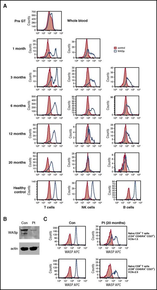 Figure 2. Correction of WASp expression post-GT. (A) WASp protein expression in T cells, B cells, and natural killer cells. (B) Western blot demonstrating WASp expression in the patient’s platelets (Pt) compared with a healthy control (con). NB, patient received no platelet transfusions at any time. (C) WASp expression in purified naive CD4+ and CD8+ T cells at 20 months post-GT.