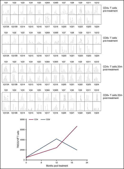 Figure 3. Improvement of T-cell repertoire and thymic output post-GT. (A) T-cell repertoire analysis by TCR spectratyping pre- and post-GT in CD4+ and CD8+ T cells. (B) sjTREC content in CD4+ (red line) and CD8+ (blue line) T cells (dotted line corresponds to the tenth centile for the patient’s age group). TRECs, T cell receptor excision circles.