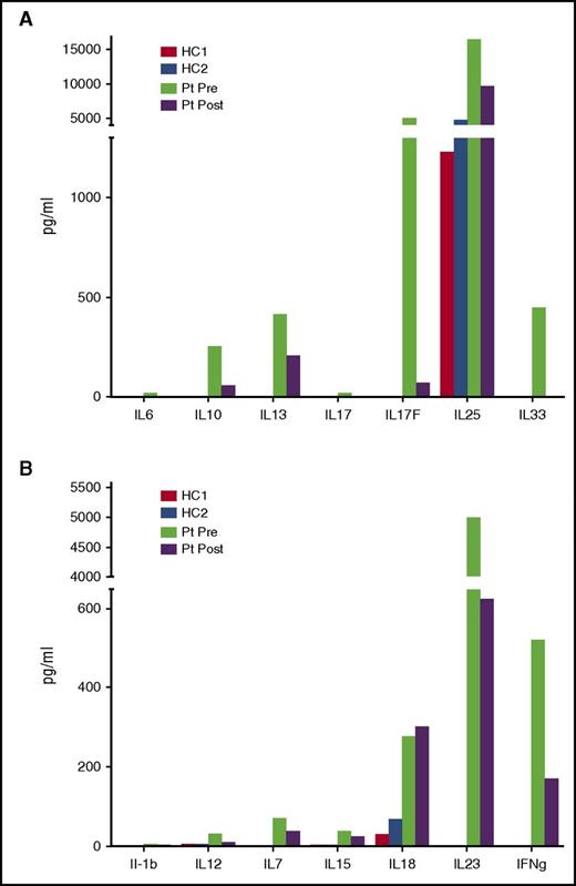 Figure 5. Reduction in serum cytokine levels post-GT. Multiple cytokines associated with predominantly lymphoid (A, top) and myeloid (B, bottom) cells were measured by luminex in the patient (Pt) pre- and 18 months post-GT and compared with healthy controls (HC1 and HC2).